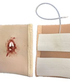 Sårmarkörskada öppen lårfraktur